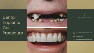 Dental Implants Procedure in Twickenham
