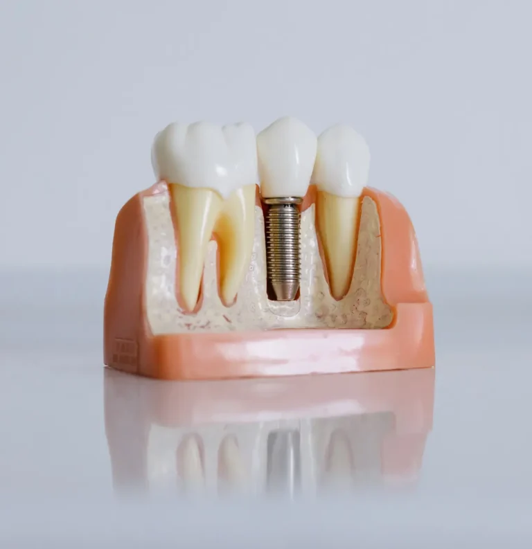 Dental implant treatment replacing a missing tooth with a natural-looking restoration
