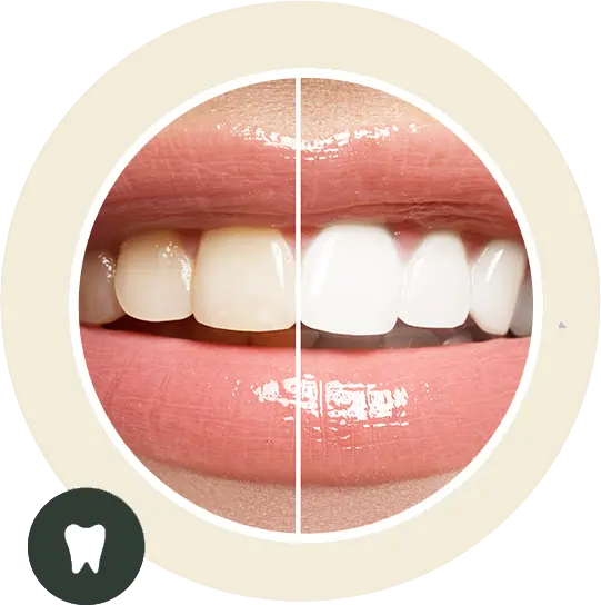 Patient showing a brighter smile after teeth whitening treatment in Twickenham