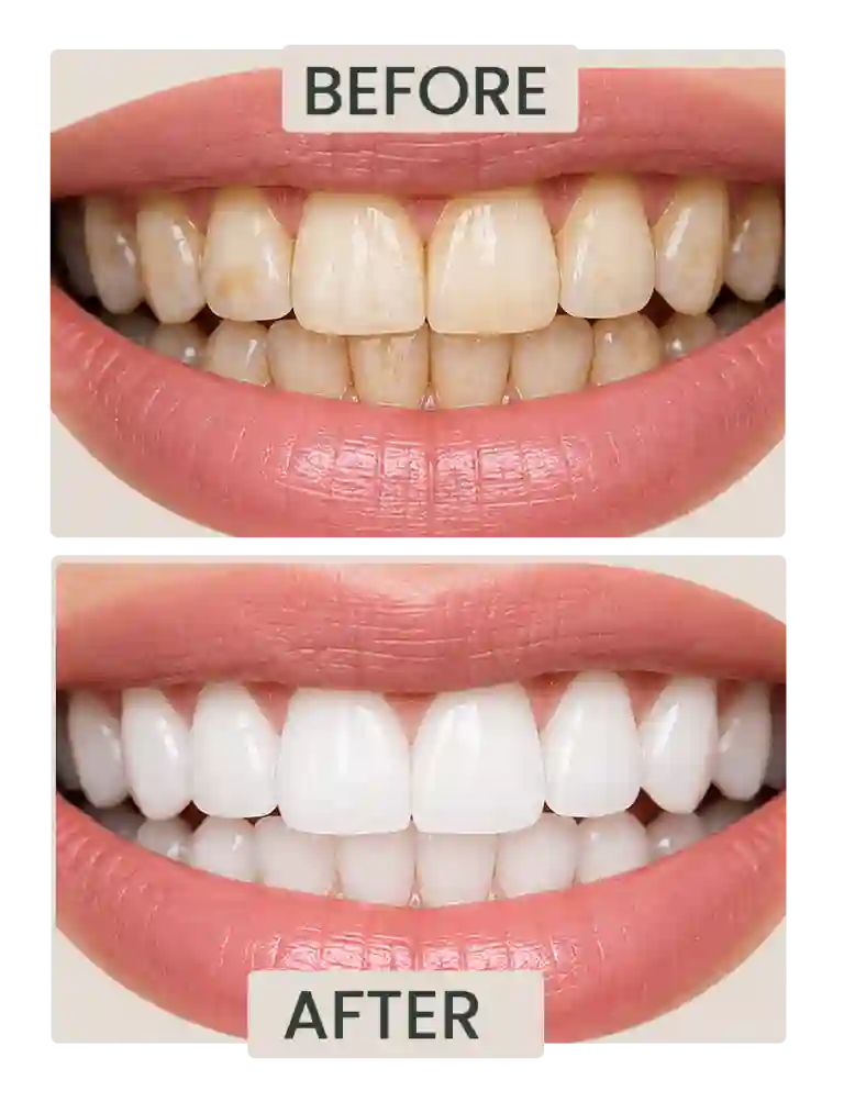 before and after teeth whitening