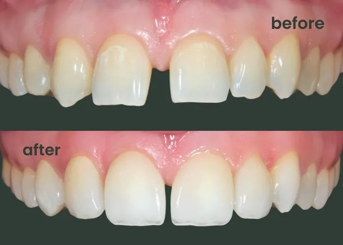 Patient smiling after cosmetic dentistry treatment in Twickenham