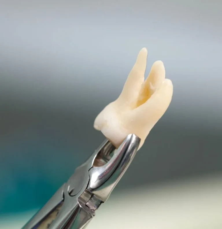 twickenham-dental-smile-tooth-extraction-in-general-dentistry
